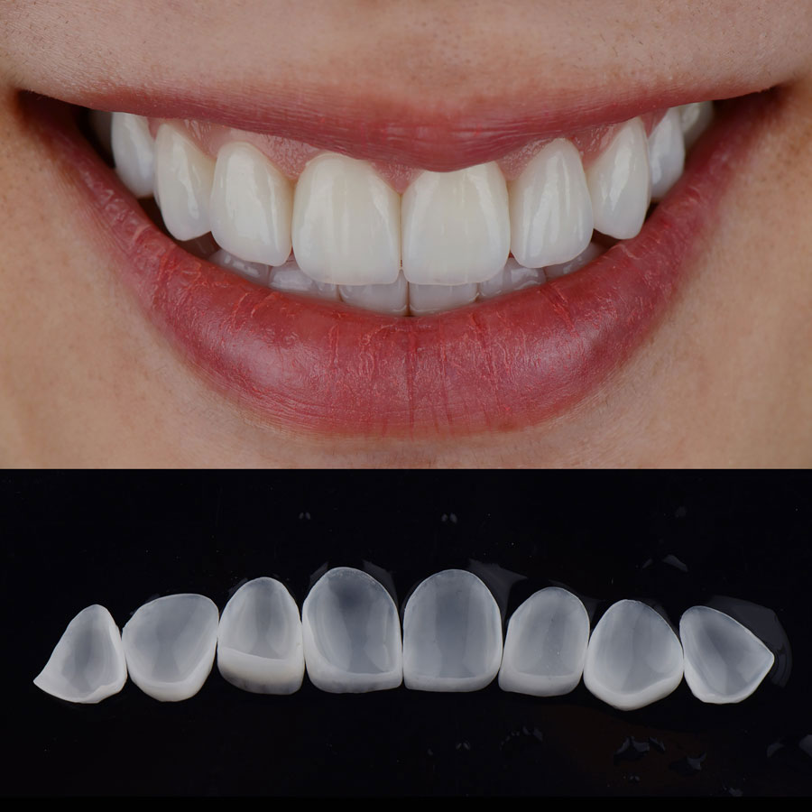 Ceramic Veneers London Specialist Dentists img