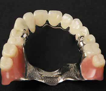 Metal-Cobalt-Chrome-Dentures-img Metal Cobalt Chrome Dentures img