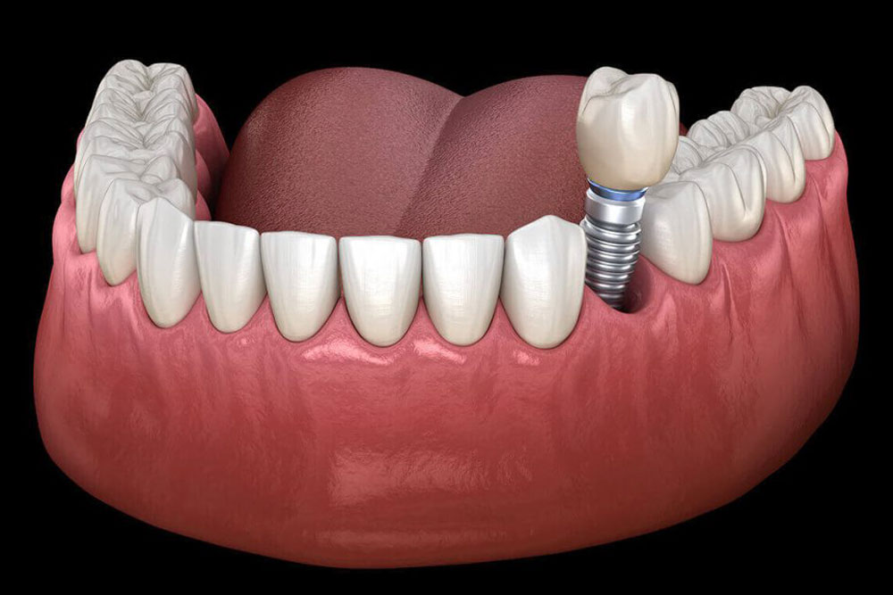 Single Implant img