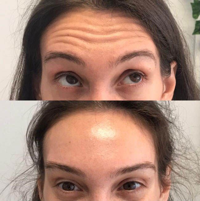 Botox before after img
