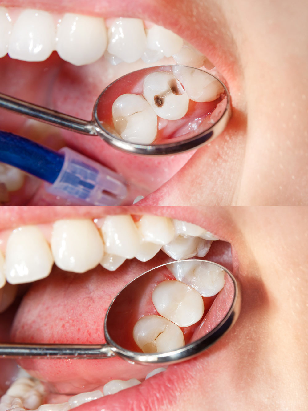 Composite filling img 2