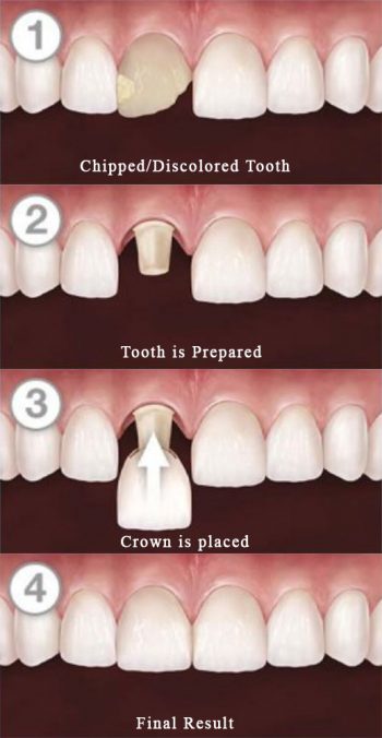 Crowns 1 2 3 4 img