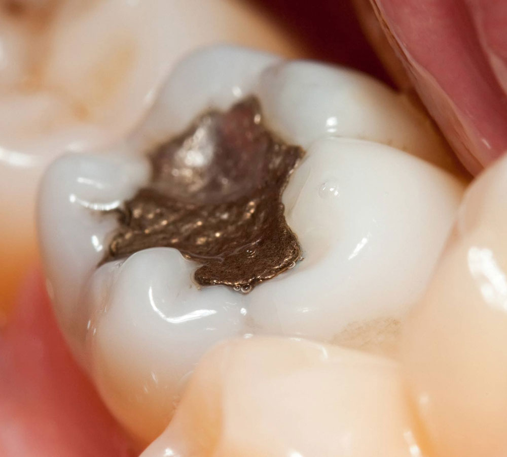 Dental amalgam longform content img
