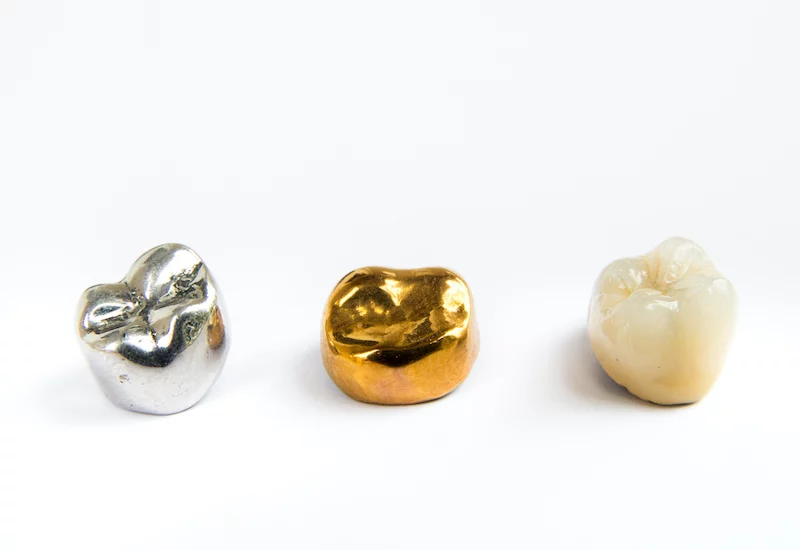 Dental crowns burlington 01