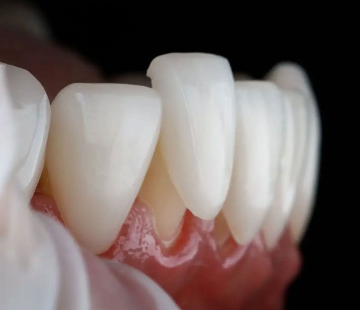 Dental veneers on lower tooth img