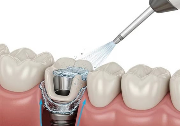 Entretien implant dentaire img