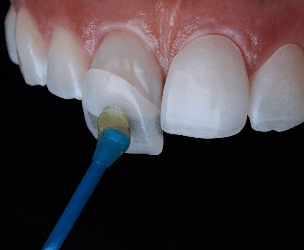 Facts about dental veneers img