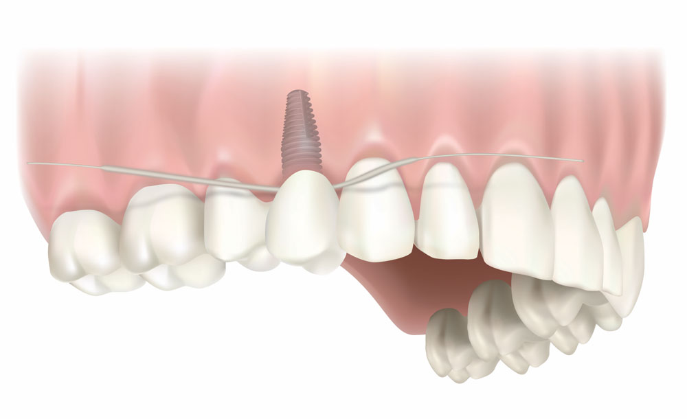 Implant hygiene img