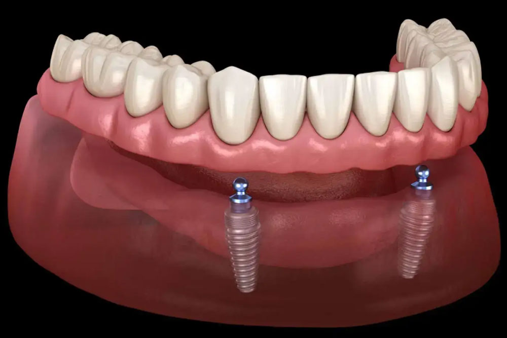 Implant supported dentures naples img