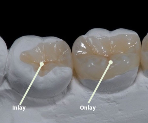 Inlay onlay img 2