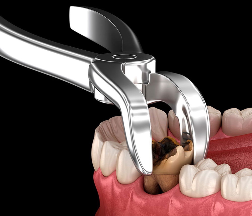 Is tooth extraction painful img