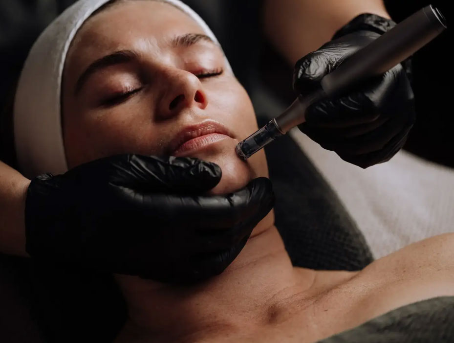 Microneedling img 2