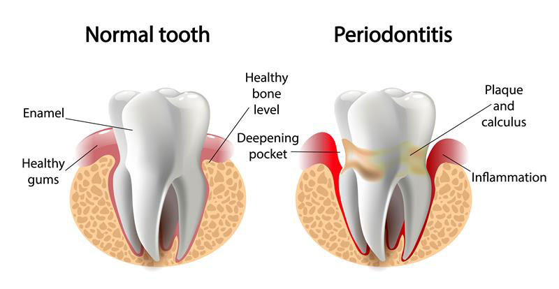Normal periodontitis img