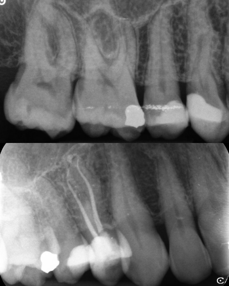 Root canal img 2