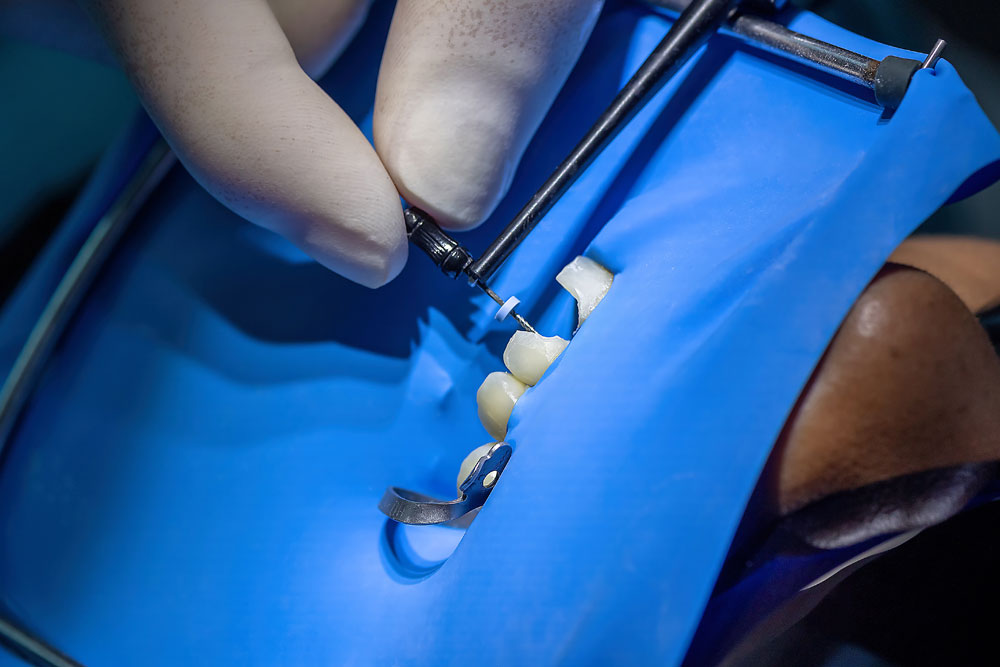 Root canal img