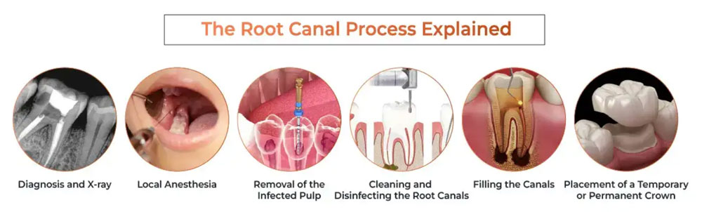 Root canal treatment img