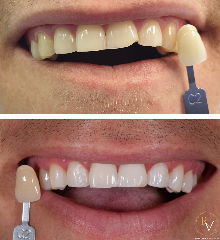 Teeth whitening img 4