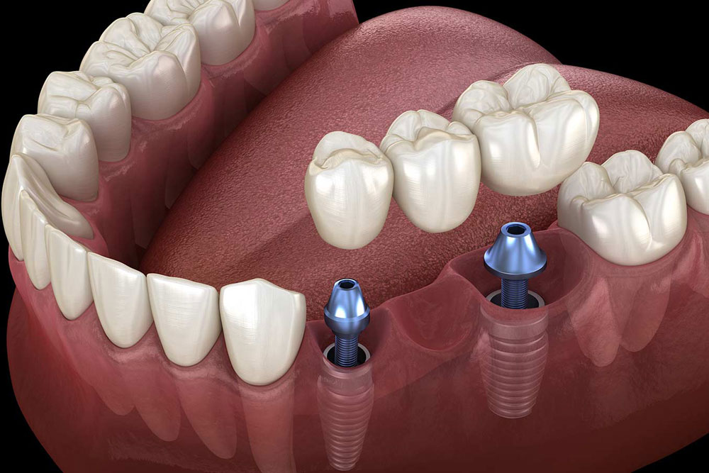 The Difference Between Dental Implants and Dental Bridges img