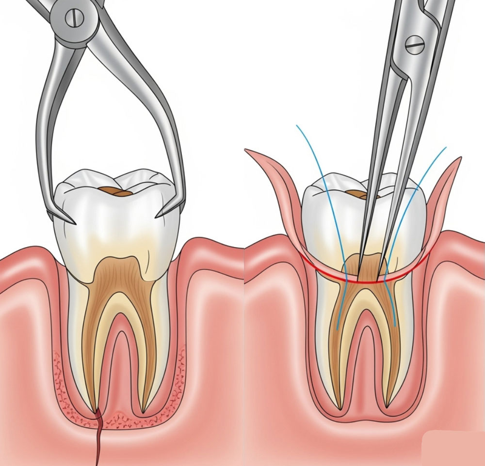 Tooth extractions img 2