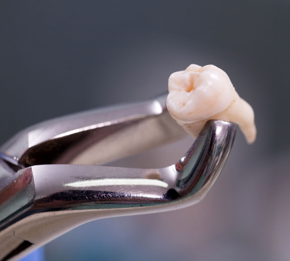 Tooth extractions img
