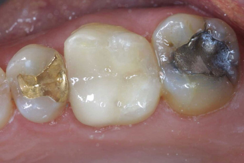 Tooth colored fillings vs metal img
