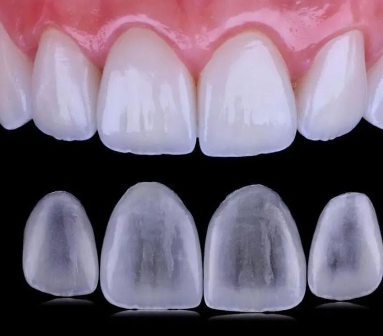 Veneer img 2