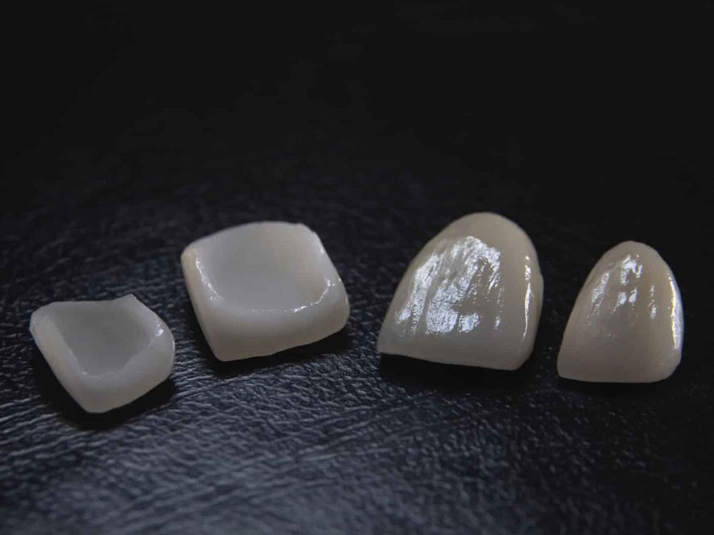 Veneers img 2