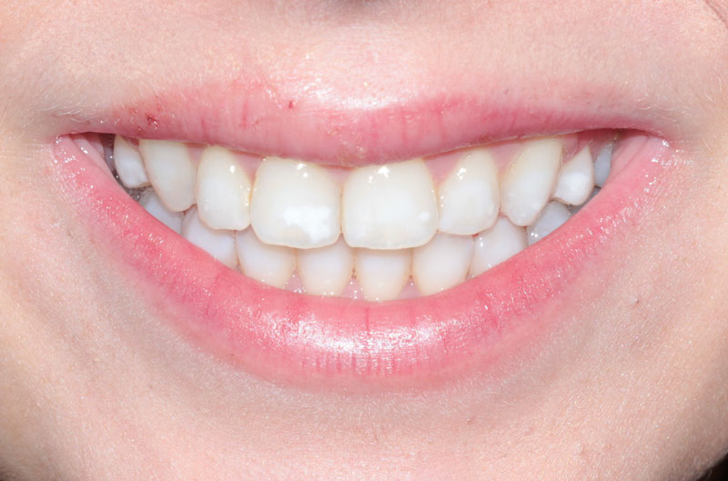 Whitening after img