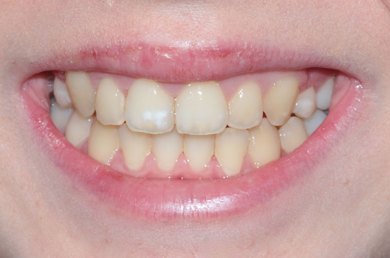 Whitening before img
