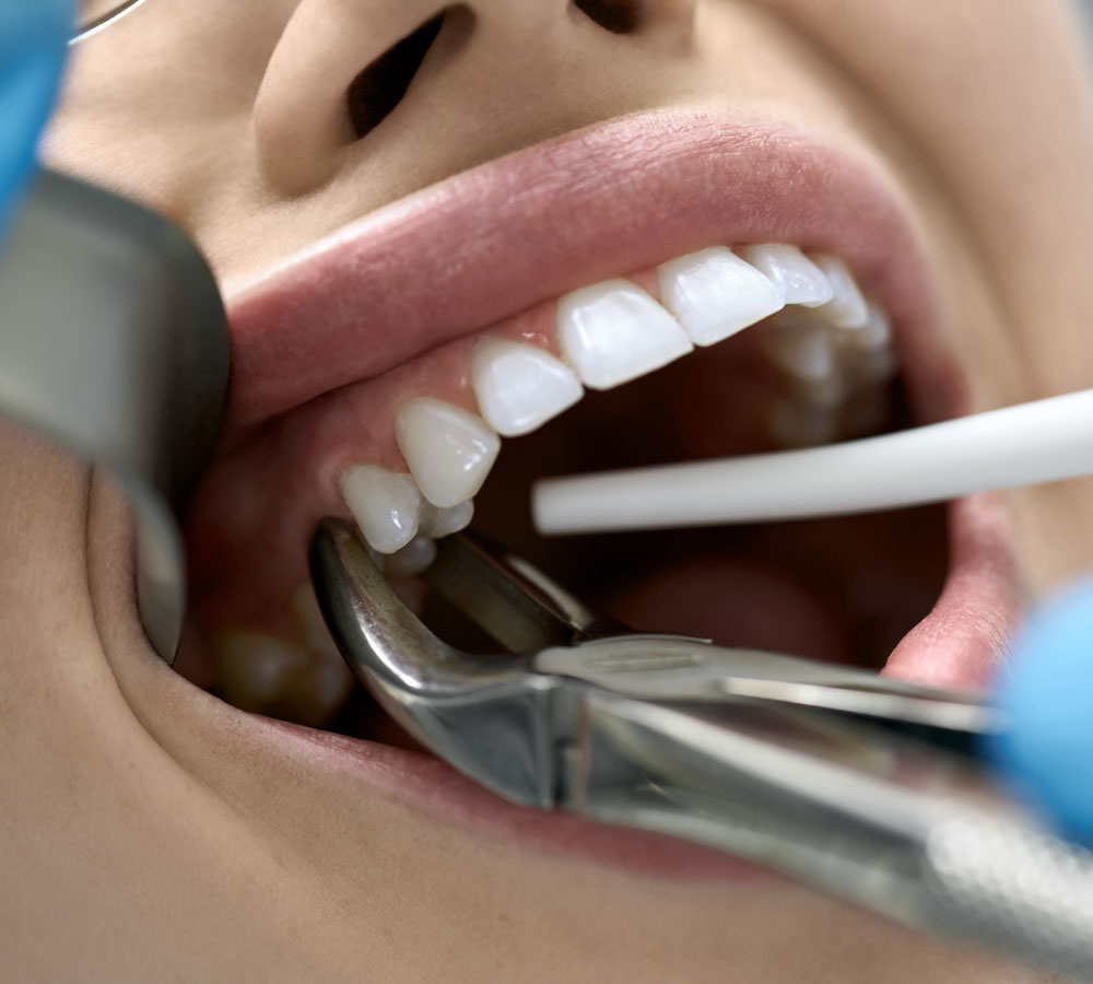 Women teeth treatment img