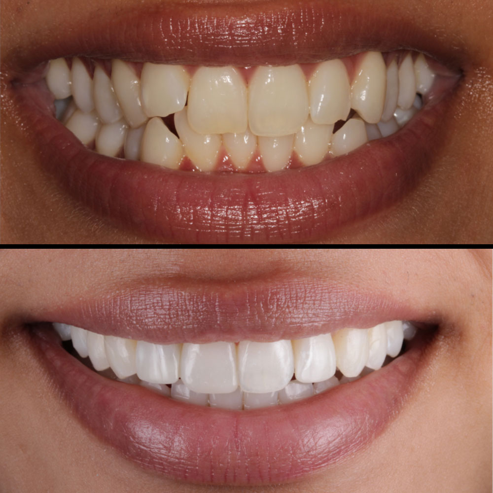 Before after 46 img