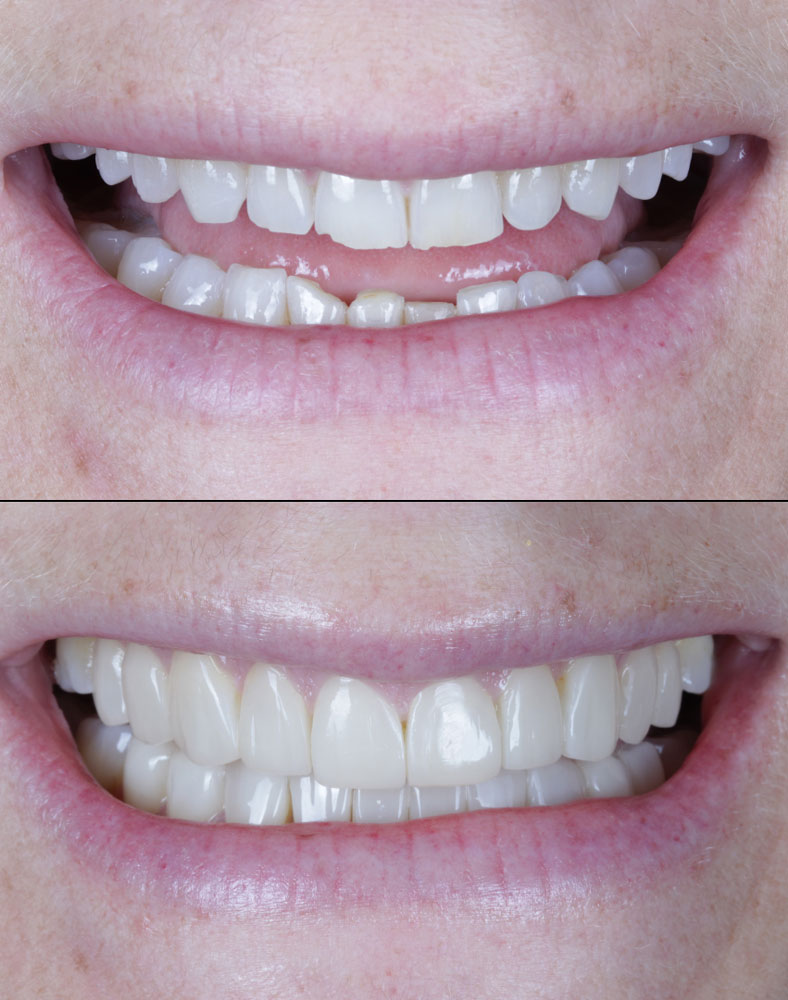 Before after 72 img