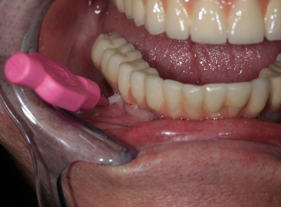 Nettoyage de la couronne sur implant img