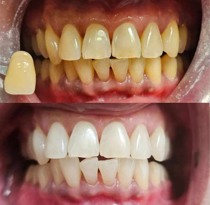 Teeth whitening img 2 2