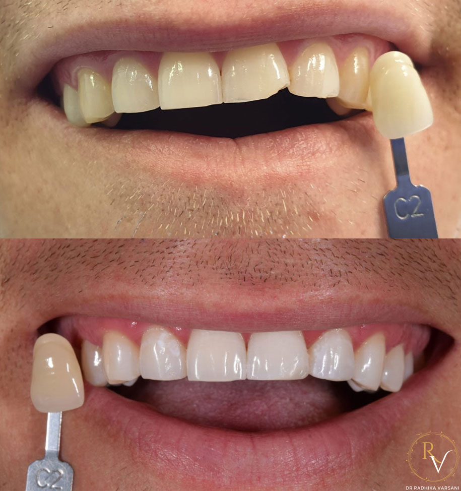 Teeth whitening img 4 2