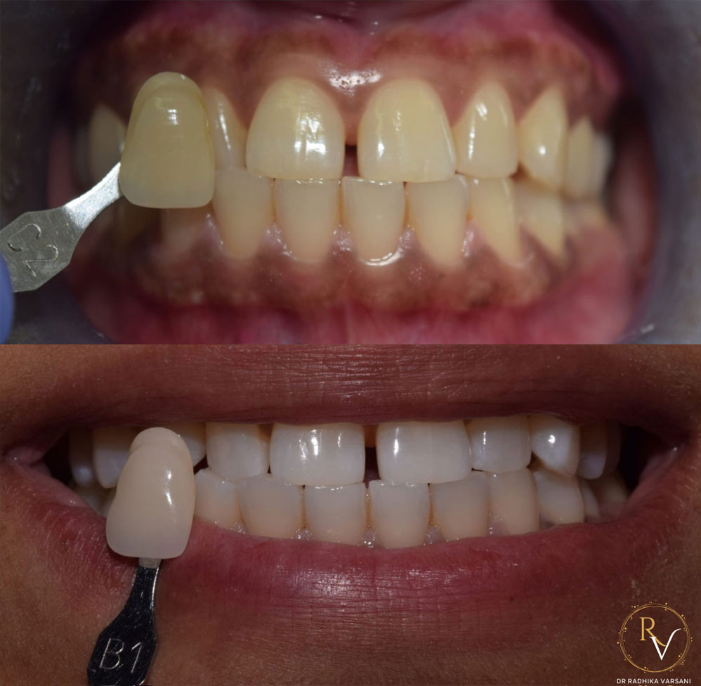 Teeth whitening img 5 2