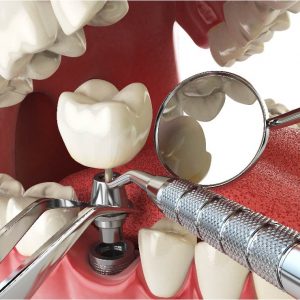 shutterstock_495859369 (Dental implant tab)use-01