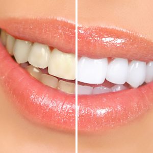 Woman,Teeth,Before,And,After,Whitening.,Over,White,Background