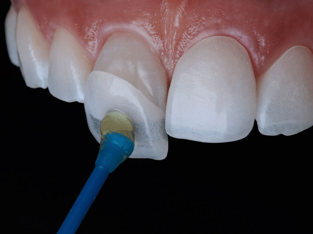 facts-about-dental-veneers-img