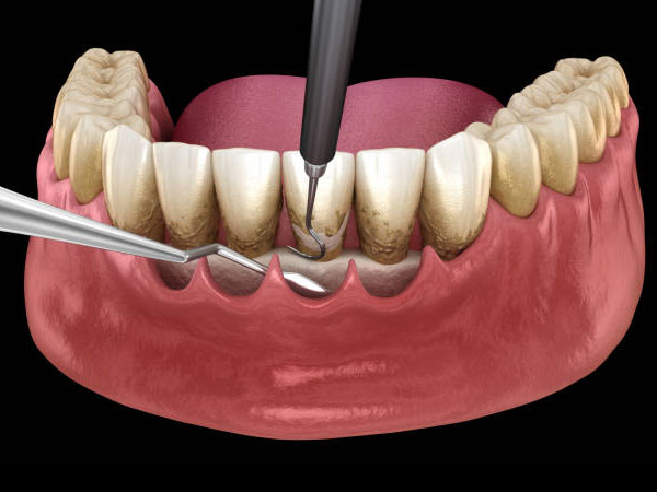 img-scaling-root-planing