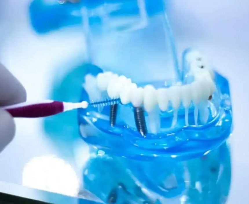 implant-hygiene-img-1