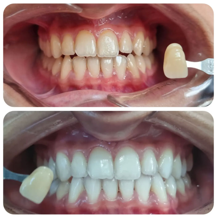 teeth-whitening-img-1