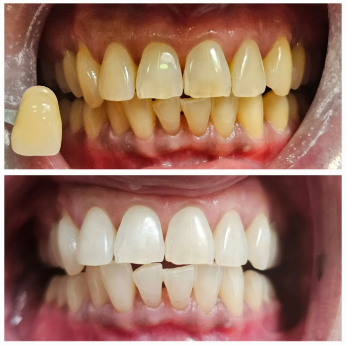 teeth-whitening-img-2