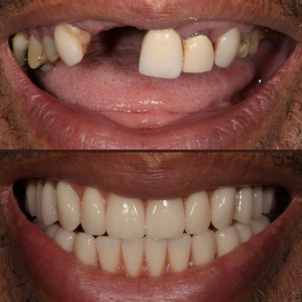 Same day teeth
