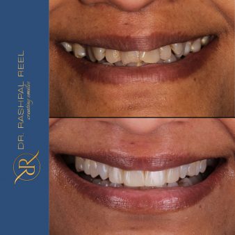 dr-rashpal-reel-before-after-img-1