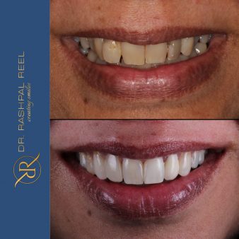 dr-rashpal-reel-before-after-img-2