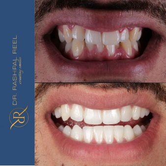 dr-rashpal-reel-before-after-img-3