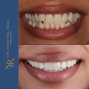 dr-rashpal-reel-before-after-img-4