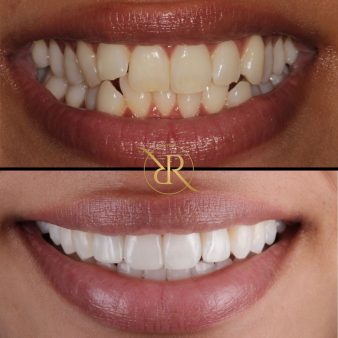dr-rashpal-reel-before-after-img-5