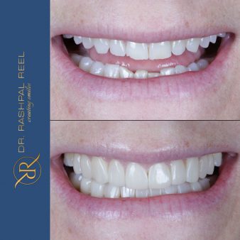 dr-rashpal-reel-before-after-img-6